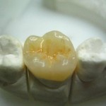 gradia onlay2-450