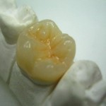 gradia onlay3-450
